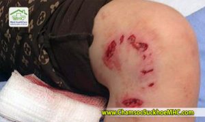 huong dan so cuu khi bi cho can