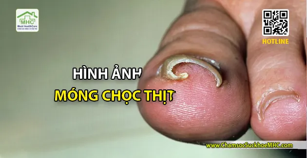 hinh anh mong choc thit ingrow toenail
