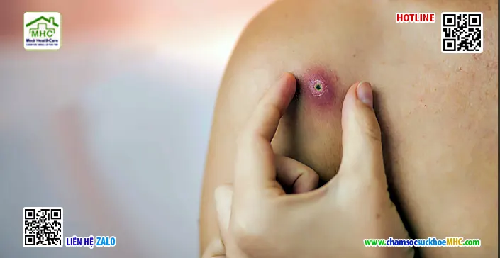 Vết thương áp xe bao lâu thì lành? 3 hinh anh vet thuong ap xe dang lanh
