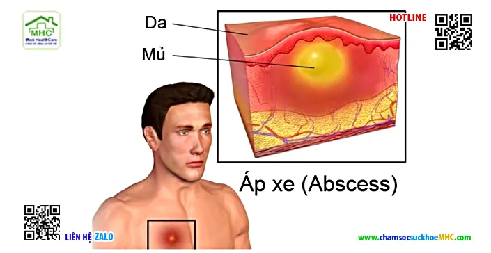 Hướng dẫn rửa vết thương áp xe tại nhà đúng cách 2 vết thương áp xe
