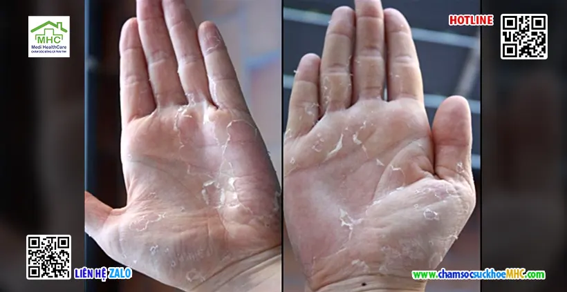 Thiếu vitamin có biểu hiện gì? Dấu hiệu và cách khắc phục hiệu quả 3 Bong tróc da tay do thiếu vitamin C