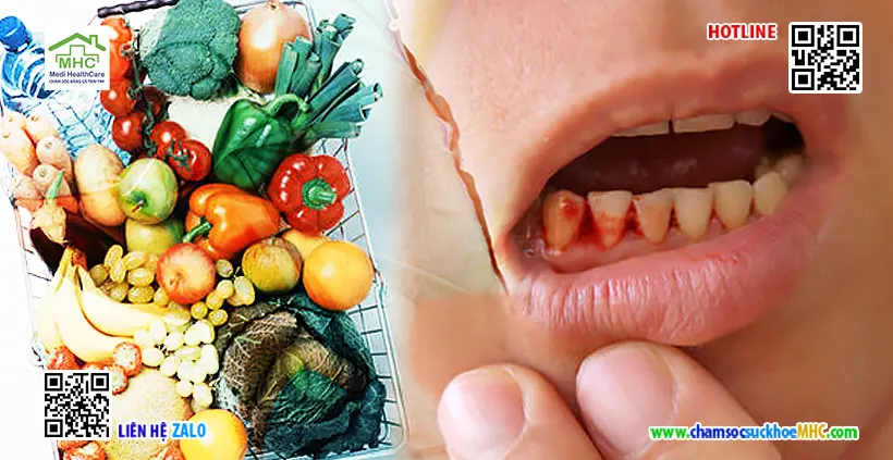 Thiếu vitamin có biểu hiện gì? Dấu hiệu và cách khắc phục hiệu quả 2 Chảy máu chân răng có thể là dấu hiệu của thiếu vitamin C
