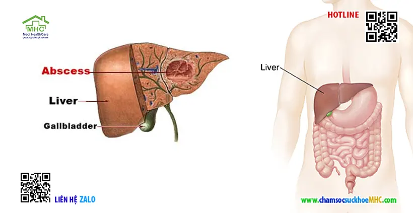 Áp xe là gì? Có nguy hiểm không? 6 Áp xe gan - liver abscess