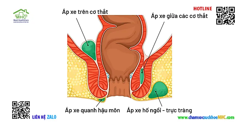 Áp xe là gì? Có nguy hiểm không? 4 Áp xe hậu môn - Áp xe quanh hậu môin