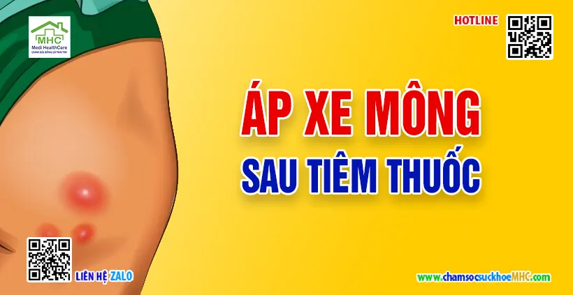 Áp xe mông sau tiêm thuốc