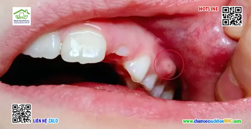 Áp xe có tự vỡ không? Có nên để áp xe tự vỡ không? 2 Áp xe răng