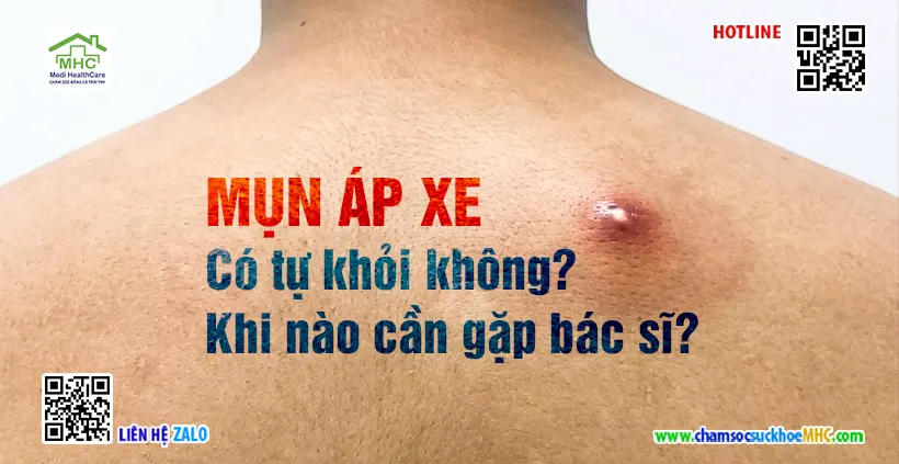 Mụn áp xe có tự khỏi không? Khi nào cần gặp bác sĩ? 1 Mụn áp xe có tự khỏi không