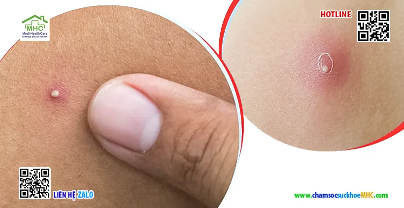 Mụn áp xe có tự khỏi không? Khi nào cần gặp bác sĩ? 4 mụn áp xe có tự khỏi không
