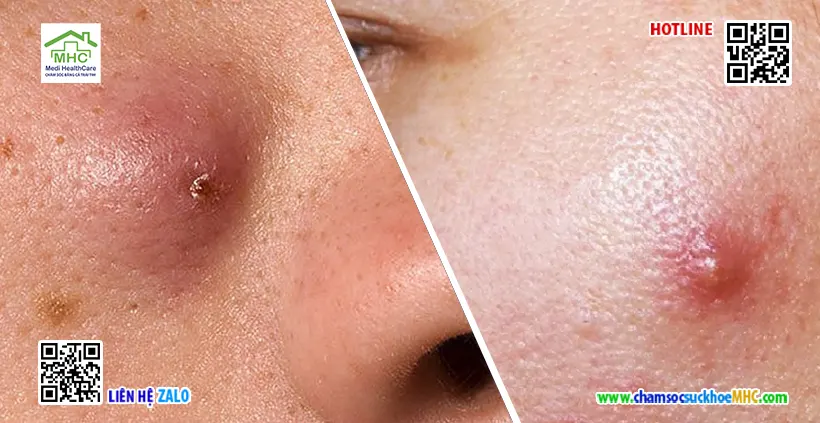 Mụn áp xe có tự khỏi không? Khi nào cần gặp bác sĩ? 2 Mụn đinh râu - mụn áp xe