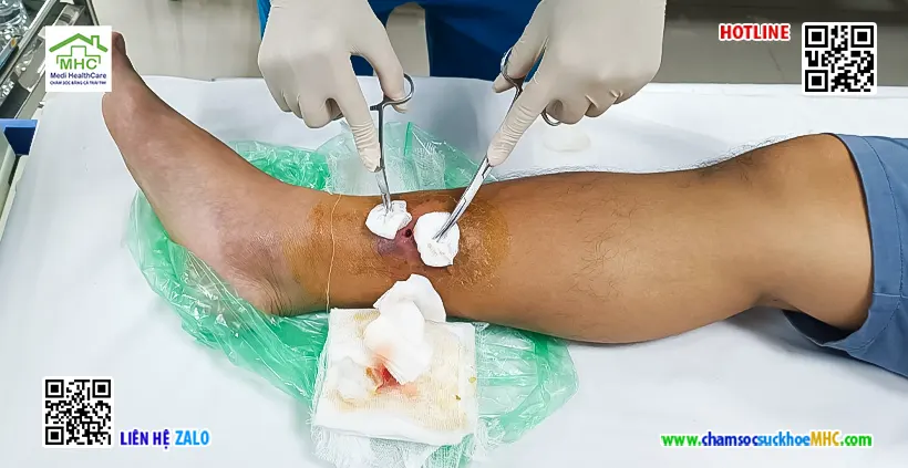 Hướng dẫn tự thay băng vết thương áp xe tại nhà 4 Thay băng áp xe