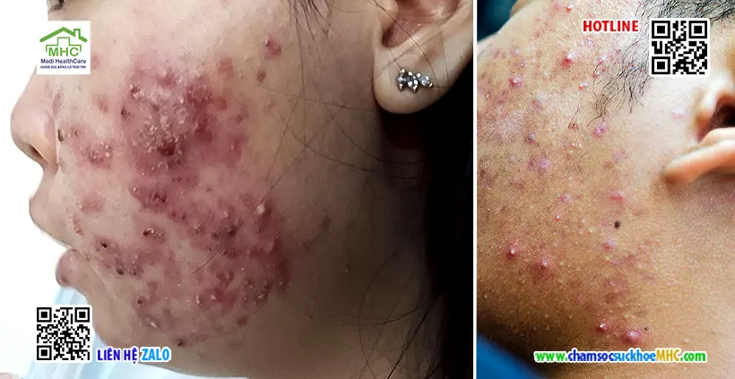 Mụn áp xe có tự khỏi không? Khi nào cần gặp bác sĩ? 3 Viêm nang lông