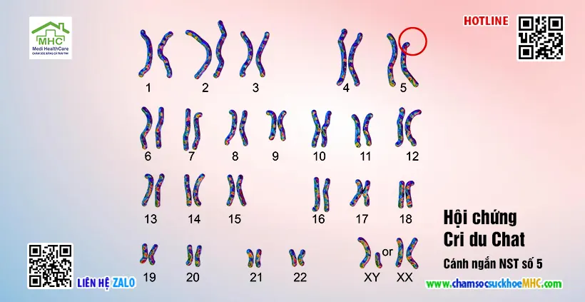 xét nghiệm nhiễm sắc thể đồ karyotype hội chứng Cri du Chat