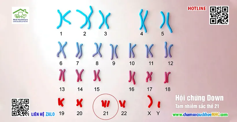 xét nghiệm nhiễm sắc thể đồ karyotype hội chứng down