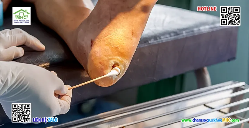 Dịch vụ y tế tại nhà quận Tân Bình - Tiện lợi, nhẹ nhàng 4 thay băng bàn chân tiểu đường y tế tại nhà tphcm