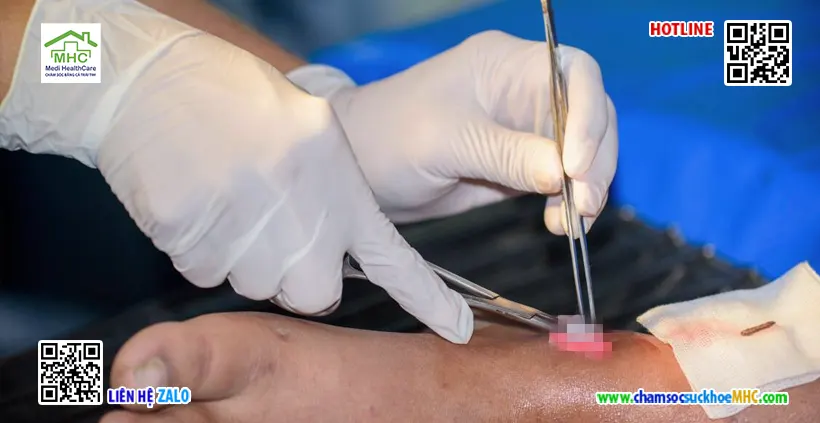 Chăm sóc vết thương tại nhà Tân Bình – An toàn, tiện lợi 3 chăm sóc vết thương tại nhà Tân Bình